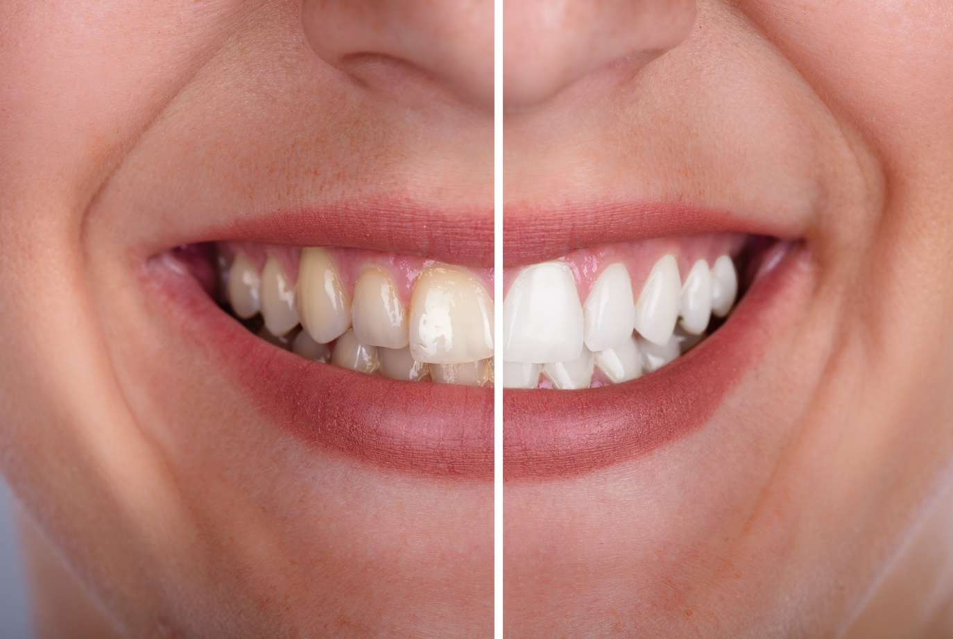A bright, white smile after Philips Zoom whitening at Chapeltown Dental Care, Sheffield