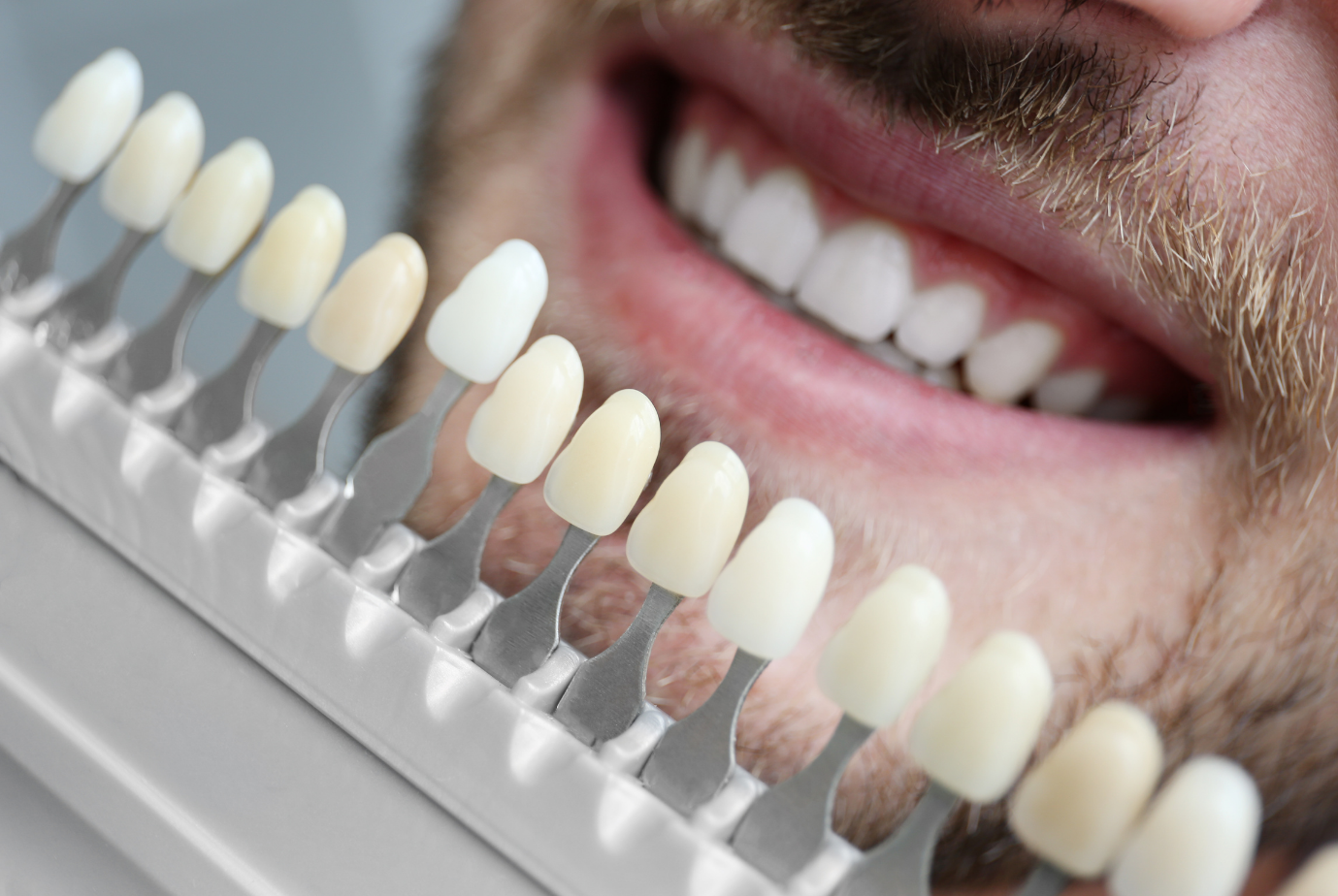 A natural-looking veneers smile makeover at Chapeltown Dental Care, Sheffield