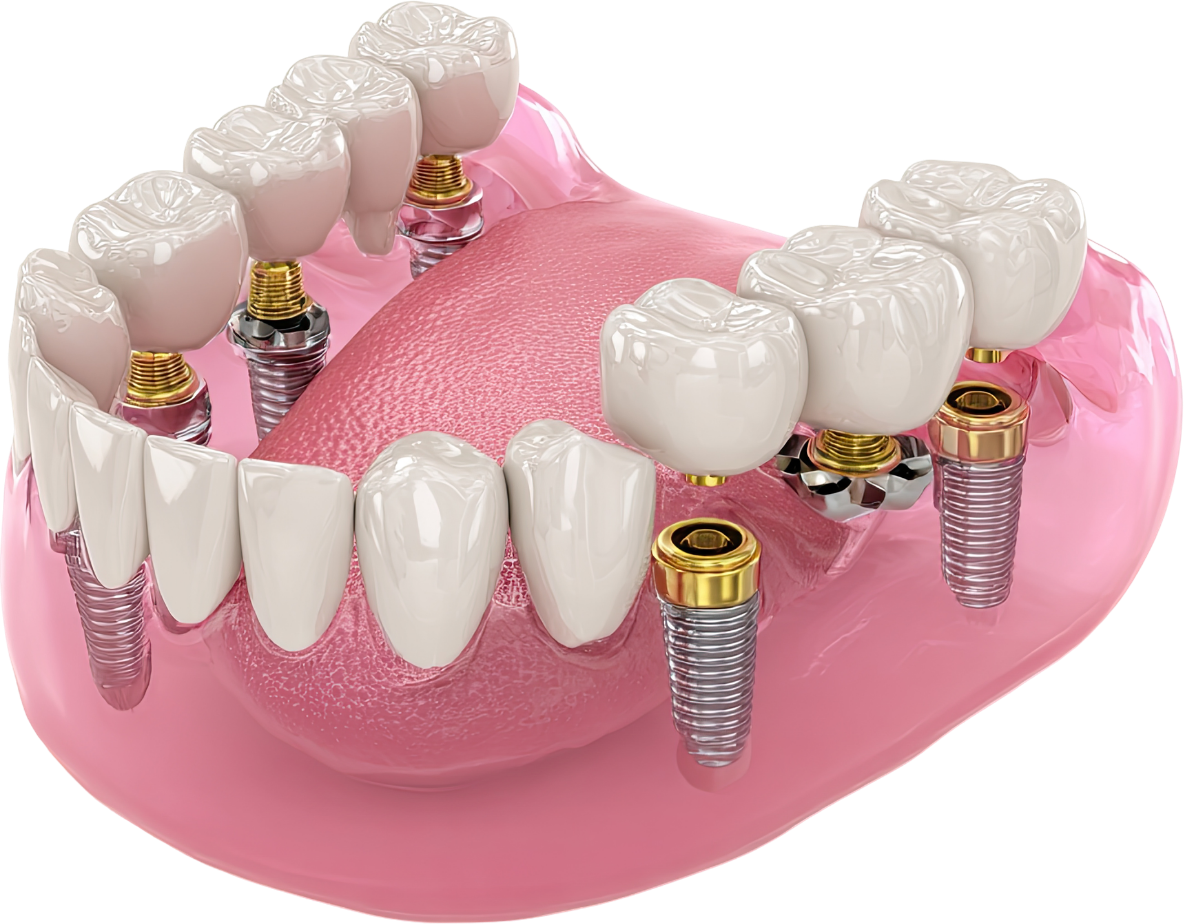 A natural-looking dental implant at Chapeltown Dental Care, Sheffield